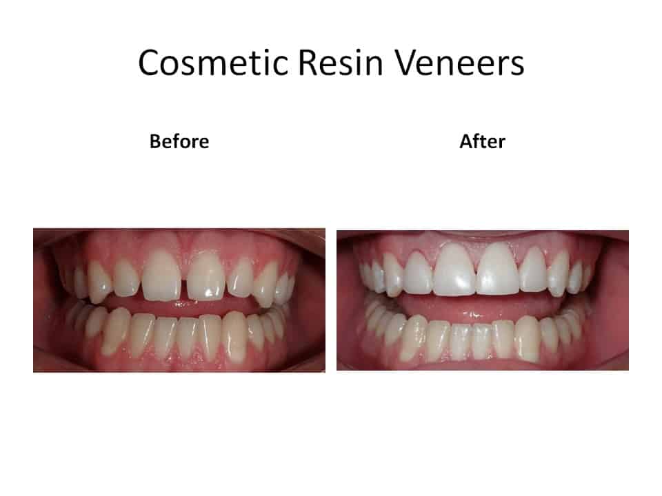Cosmetic resin veneer pictures of before and after
