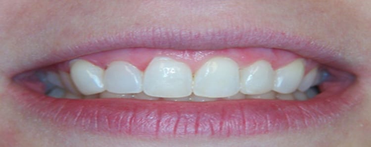 Before and After Smile 6