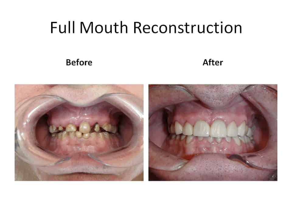 Before and after of a full mouth reconstruction case
