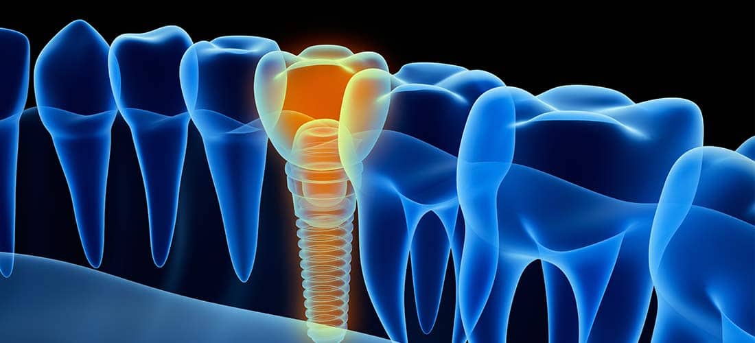 Dental Implants Geneva