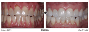 Pinhole Surgery Technique