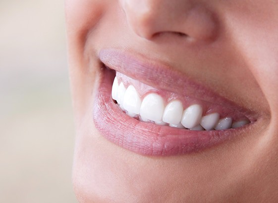 SmileSimplicity-in-Geneva-Dentist-Veneers