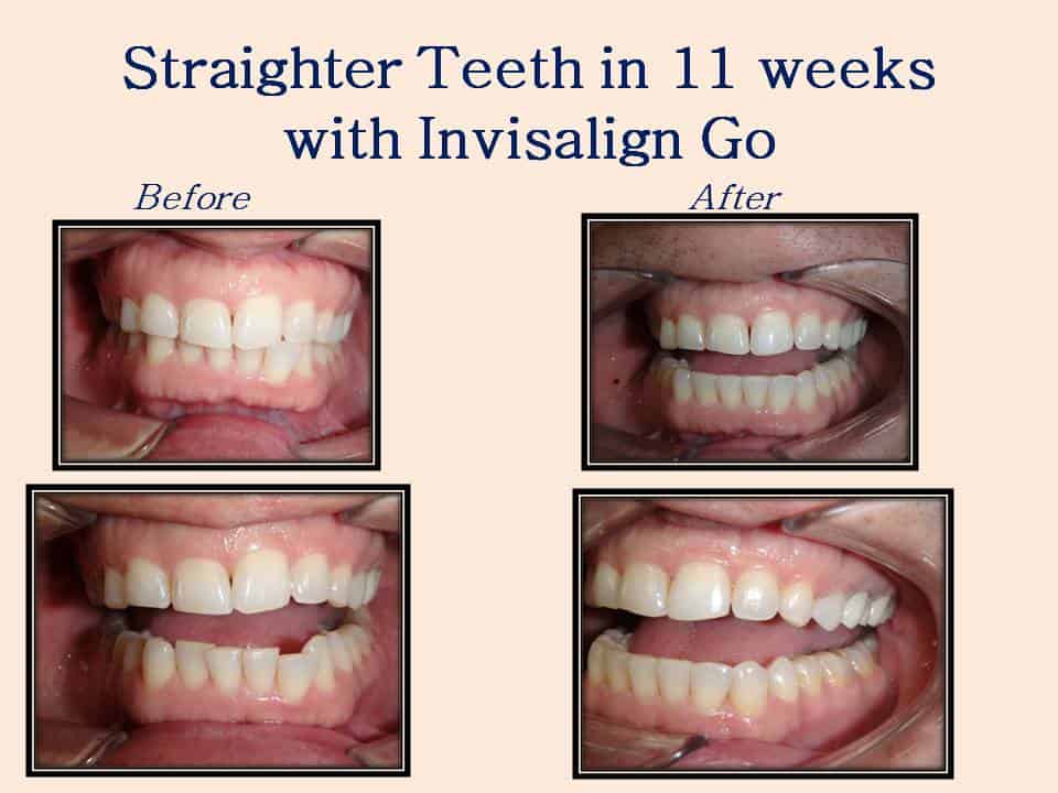 Straighter teeth in 11 weeks with Invisalign Go