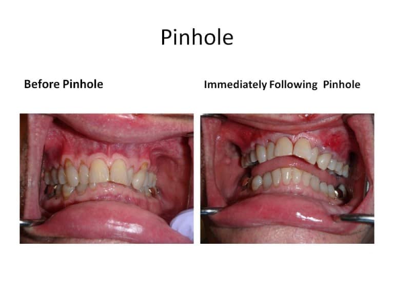 Pinhole Surgery Technique Gum Recession & PST Geneva IL Dentist