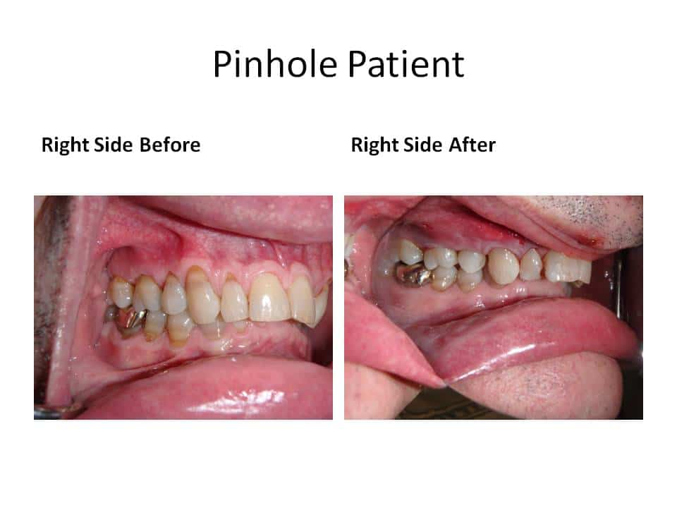 Pinhole Surgery Technique Gum Recession & PST Geneva IL Dentist