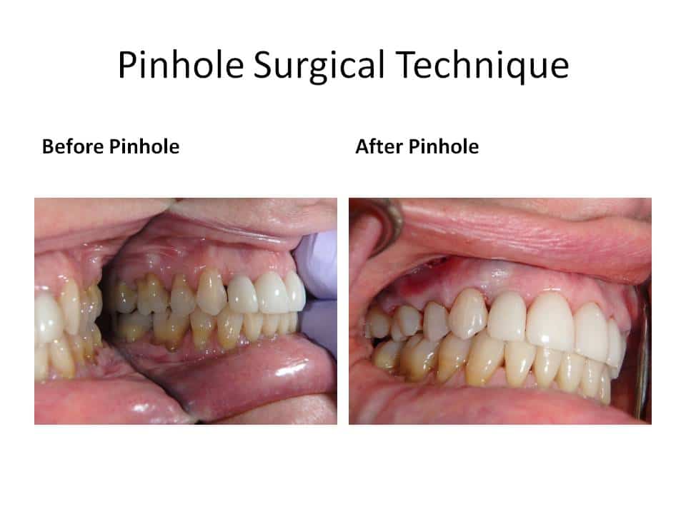 Pinhole Surgery Technique Gum Recession And Pst Geneva Il Dentist